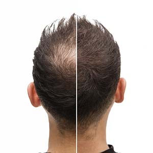 alopecia before and after